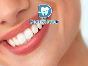 تفاوت لمینت و کامپوزیت در جلوه لبخند