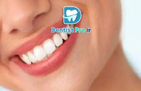 تفاوت لمینت و کامپوزیت در جلوه لبخند