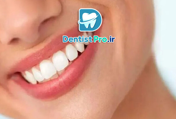 تفاوت لمینت و کامپوزیت در جلوه لبخند 27 تفاوت لمینت و کامپوزیت در جلوه لبخند