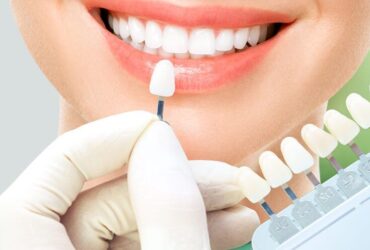 لمینت متحرک دندان چیست؟ مزایا و معایب آن