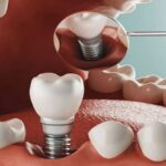 روش‌های کاشت ایمپلنت دندان و انتخاب بهترین نوع آن