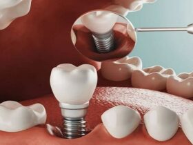 روش‌های کاشت ایمپلنت دندان و انتخاب بهترین نوع آن