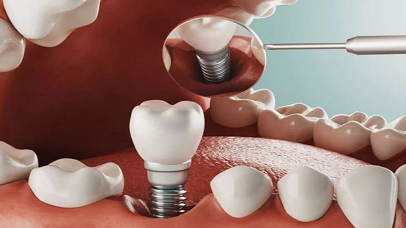 روش‌های کاشت ایمپلنت دندان و انتخاب بهترین نوع آن