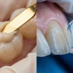 برای چه دندان‌ها و افرادی کامپوزیت بهتر از لمینت است؟