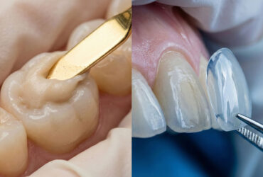 برای چه دندان‌ها و افرادی کامپوزیت بهتر از لمینت است؟