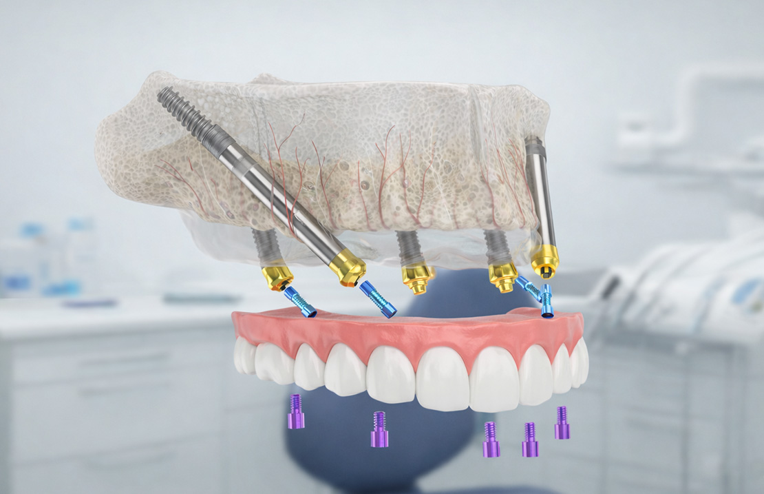 ایمپلنت زایگوماتیک