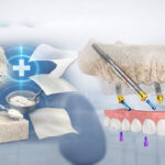 بهترین روش جایگزین پیوند استخوان برای ایمپلنت دندان