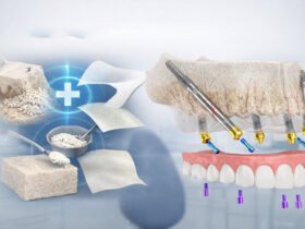 بهترین روش جایگزین پیوند استخوان برای ایمپلنت دندان
