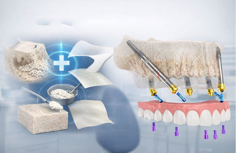 بهترین روش جایگزین پیوند استخوان برای ایمپلنت دندان