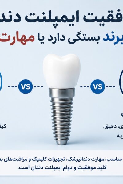 موفقیت ایمپلنت دندان بیش‌تر به برند بستگی دارد یا مهارت پزشکی؟