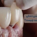 لق شدن دندان کناری ایمپلنت