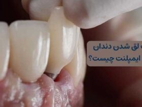 لق شدن دندان کناری ایمپلنت