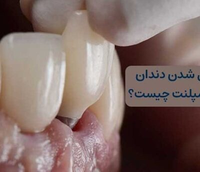 لق شدن دندان کناری ایمپلنت