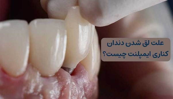لق شدن دندان کناری ایمپلنت