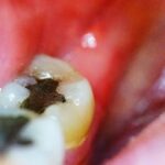 پر کردن دندان با آمالگام هنوز ارزش دارد؟