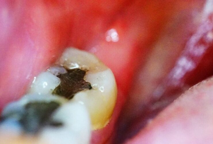 پر کردن دندان با آمالگام هنوز ارزش دارد؟