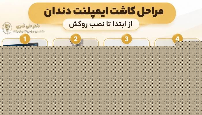 مراحل کاشت ایمپلنت دندان از ابتدا تا نصب روکش چگونه است